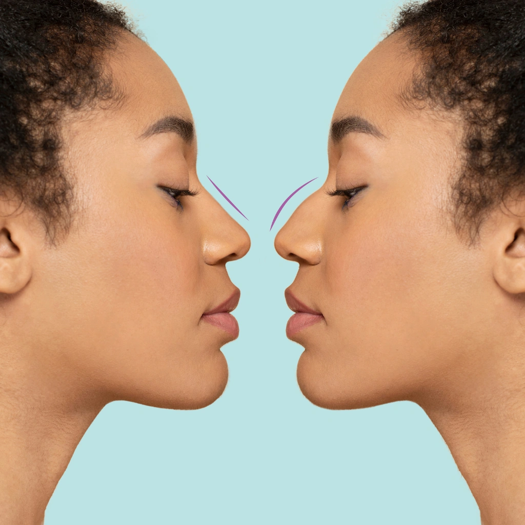 Vorher und Nachher Nasenkorrektur ohne OP – harmonische Nasenkontur, geglätteter Nasenrücken und ästhetisches Profil