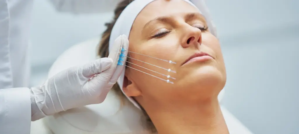„Behandlungsbereiche Fadenlifting – Stirn, Wangen, Kinn und Gesichtskonturen für sanfte Straffung und Lifting ohne OP